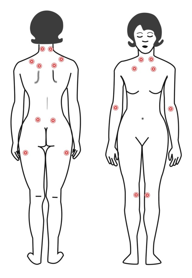 Fibromyalgie