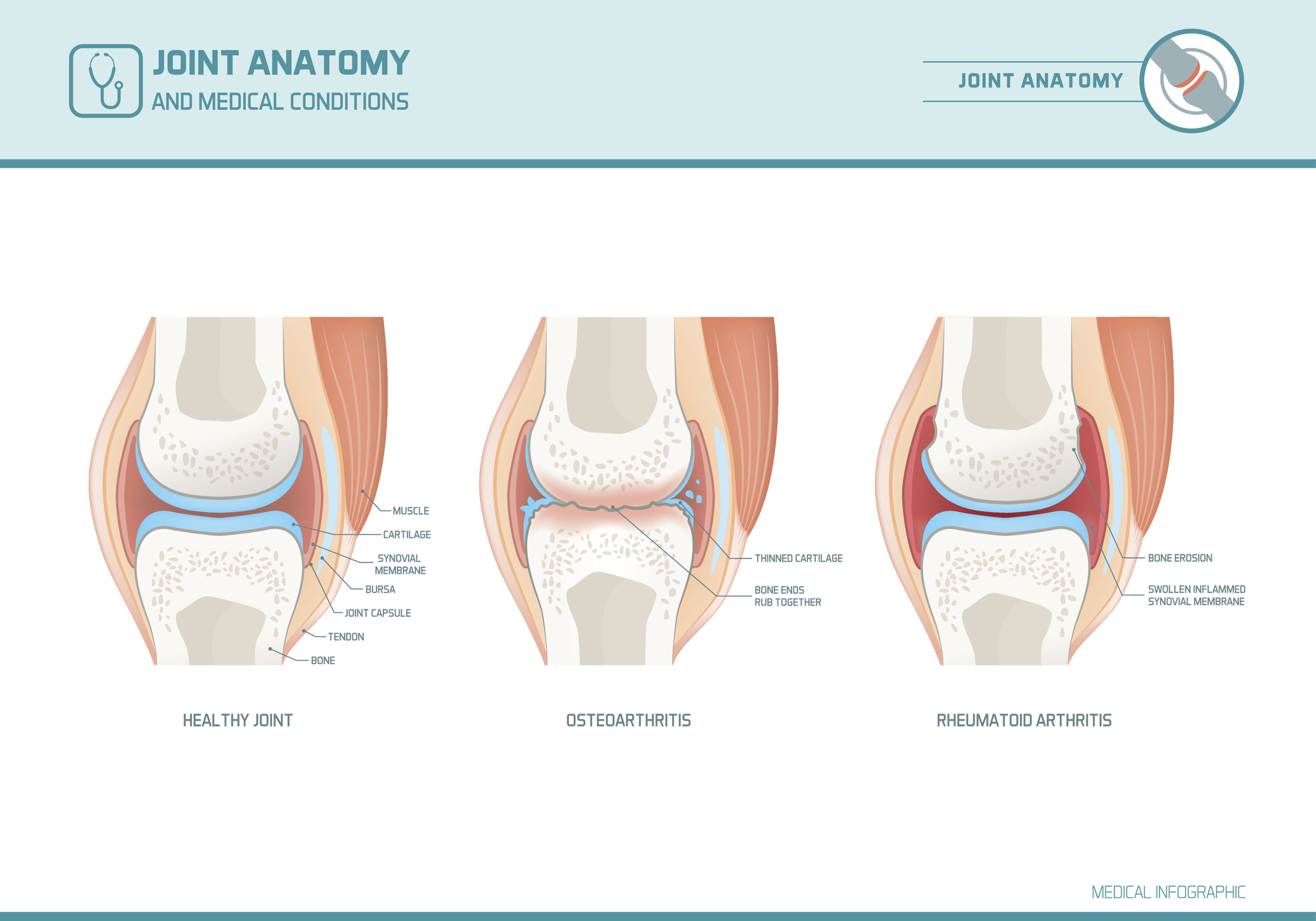 Artrose, Artritis en Rematoïde Artritis